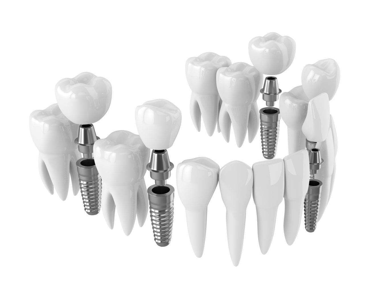 Dental Implants in Hanover MD Implant Dentistry Severn