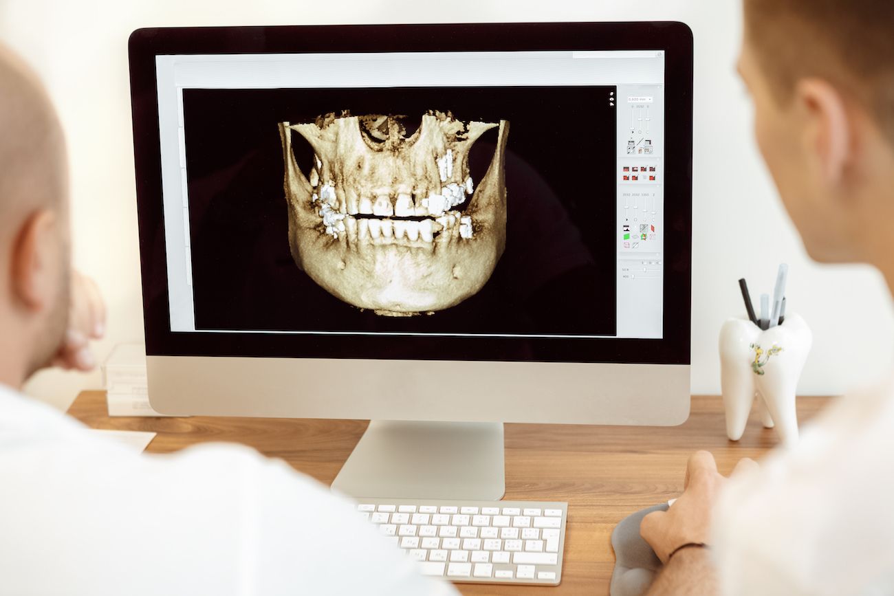 how-can-i-regain-jawbone-structure-implant-dentistry-in-hanover-md